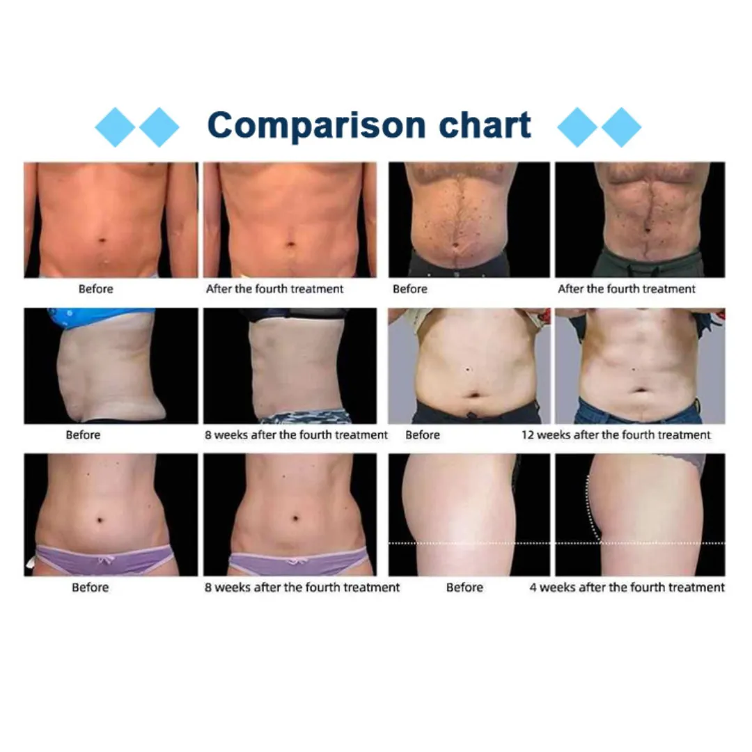 EMShape Neo® Elite with Upgraded Higher Power